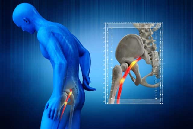 blue image of man and hip with red nerve highlighted on hip